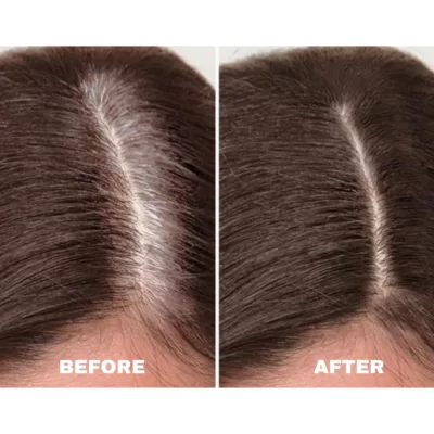 Ultimate Hair Loss Therapy before after